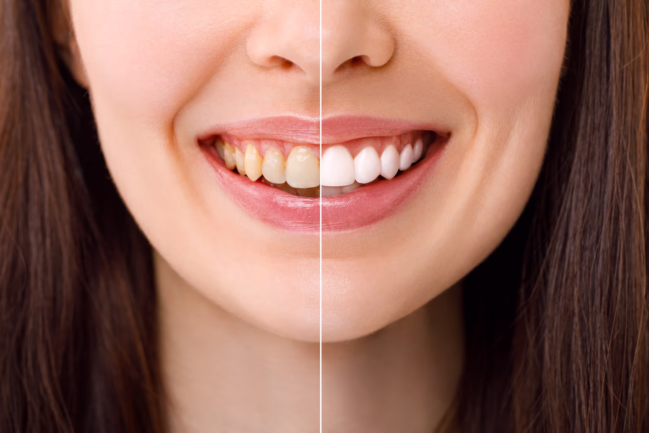 Illustration for blog post: Teeth Whitening Your Ultimate Guide to a Radiant Smile