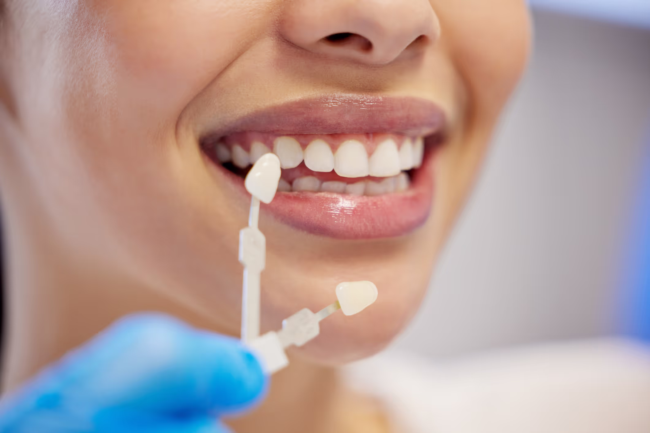 Illustration for blog post: Crowns & Veneers Enhancing Your Smile with Modern Dental Solutions