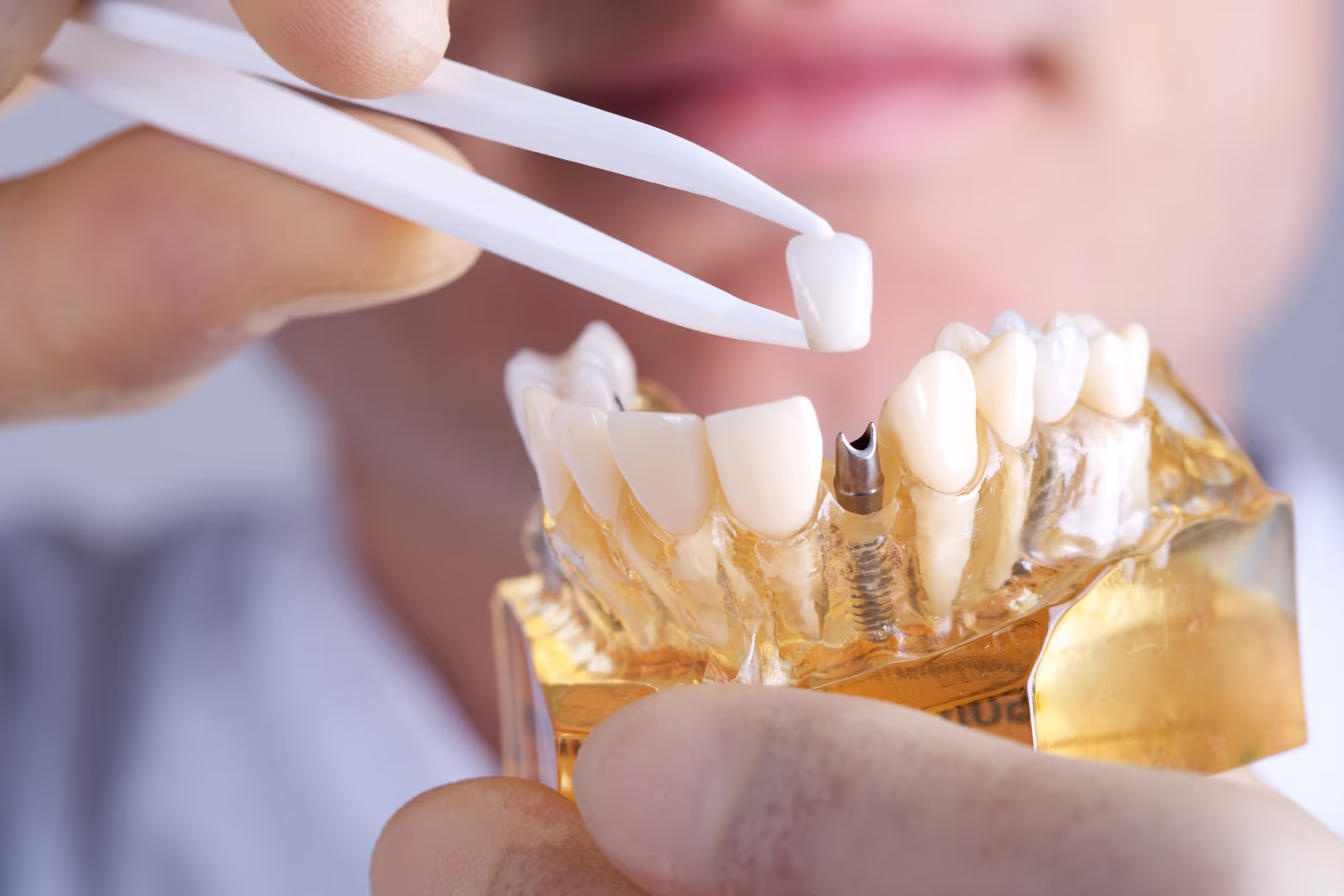 Illustration for blog post: Everything You Need to Know About Dental Implants