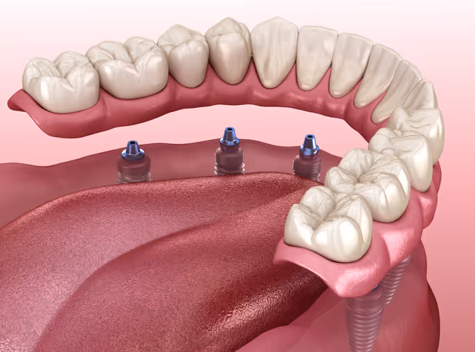 Illustration: All-on-X implants