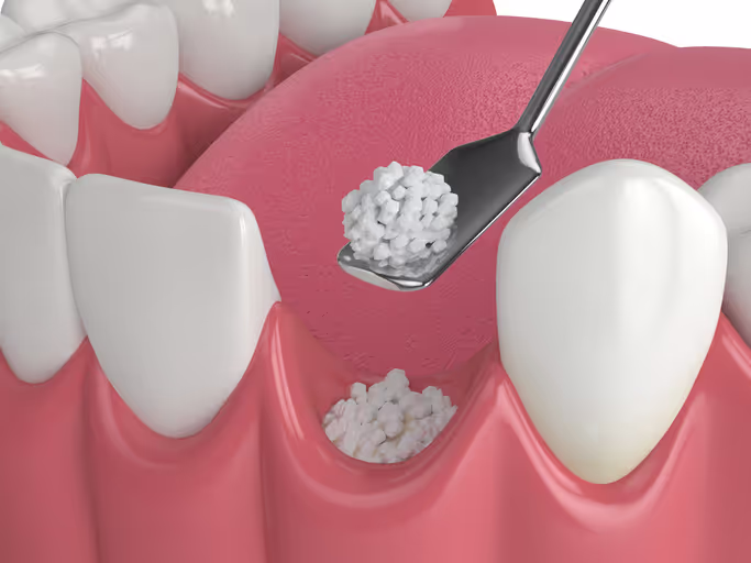 Illustration: bone grafting