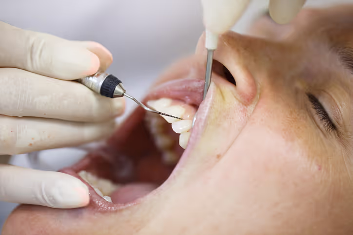 Illustration: periodontal treatments