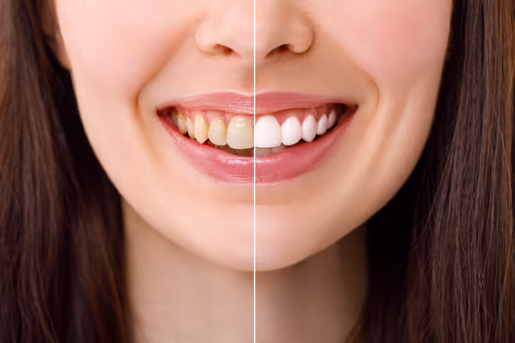 Illustration: teeth whitening
